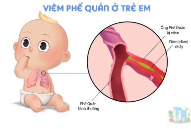 Nguyên Nhân, Cách Điều Trị Viêm Phế Quản Ở Trẻ Nguyên Nhân, Cách Điều Trị Viêm Phế Quản Ở Trẻ